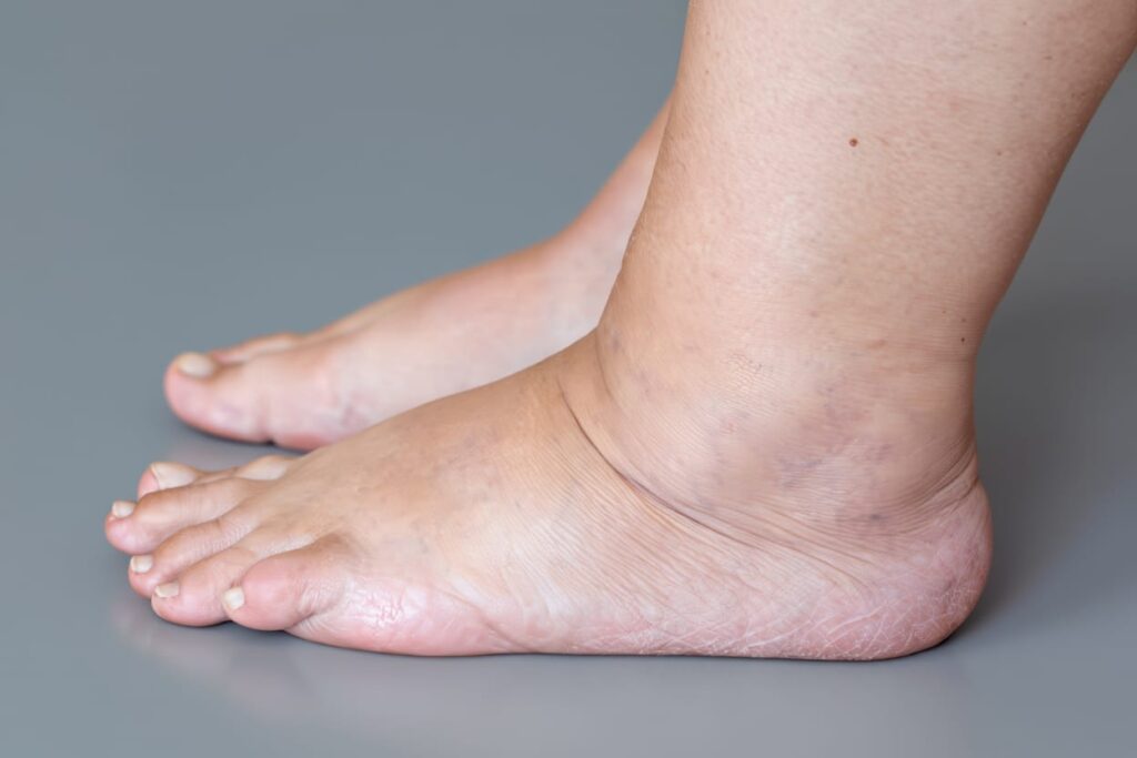 तेजी से वजन बढ़ने का कारण (Rapid weight gain in hindi)